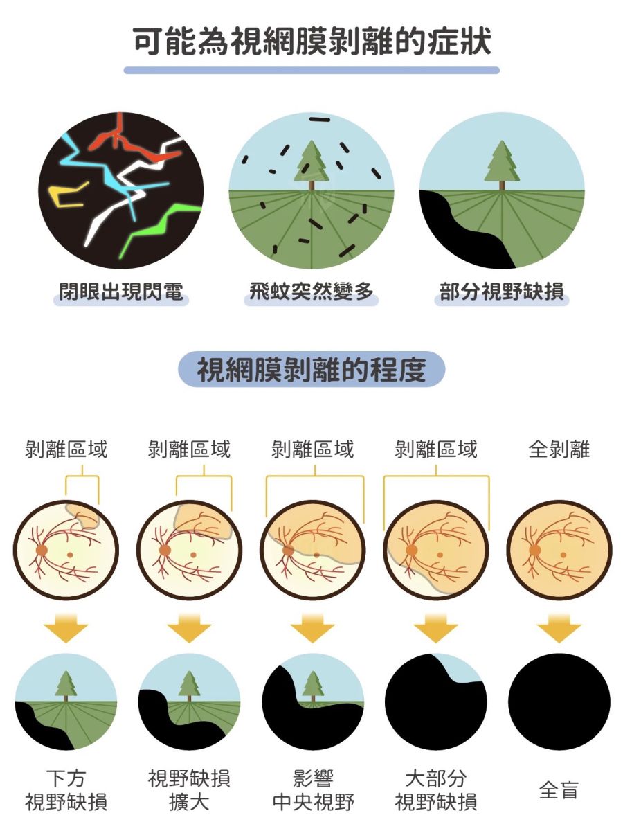 視網膜剝離不痛不癢,患者要自我觀察是否出現症狀。(圖:吳建良醫師提供)